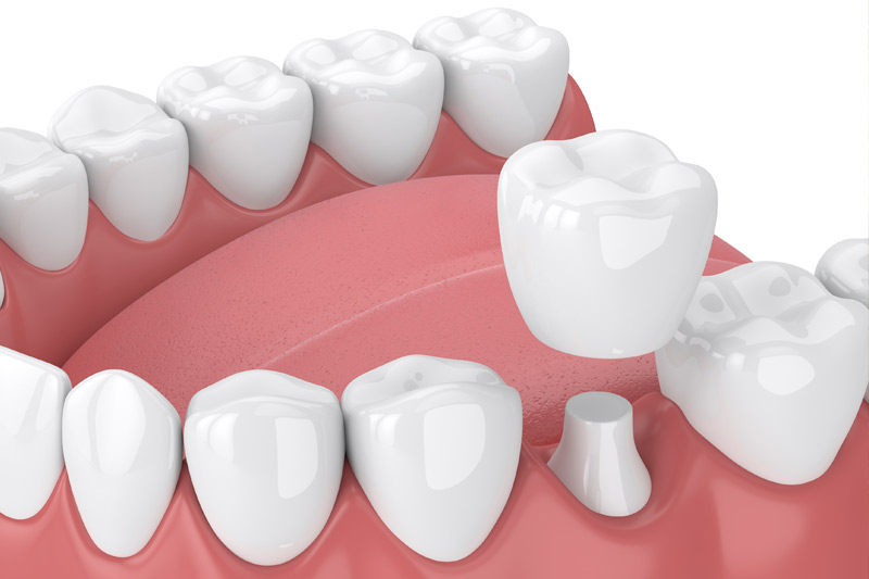 Dental Crowns in Pearland
