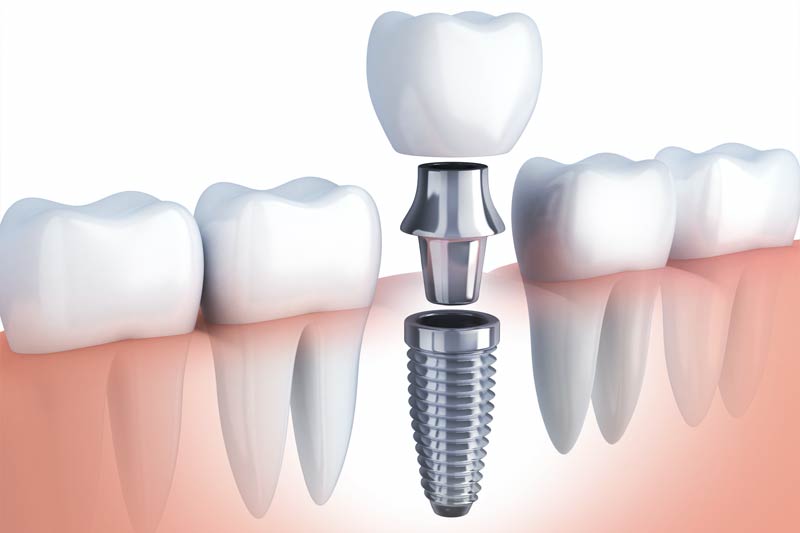 Implants Dentist in Pearland