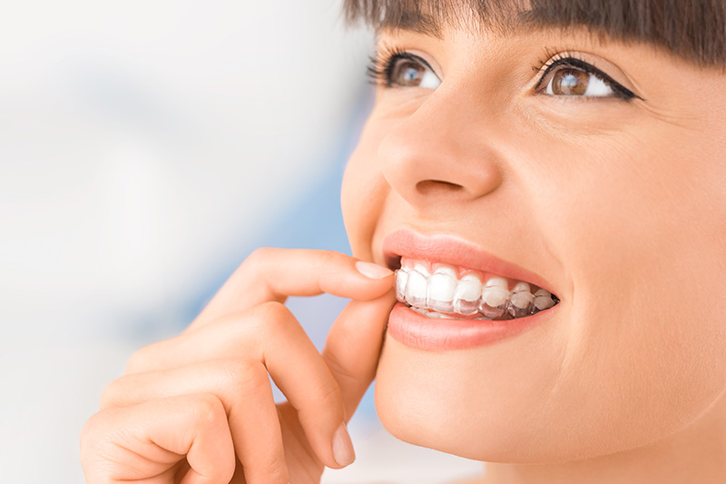 Clear Aligner Therapy in Pearland