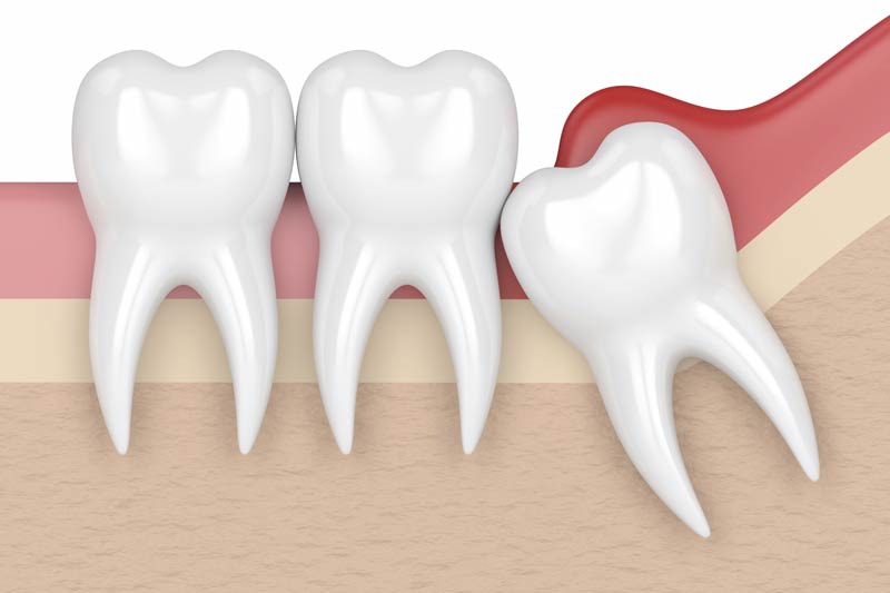 Wisdom Tooth Removal in Pearland